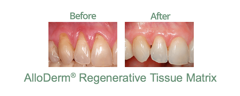 Alloderm_Gum_Graft_in_Cambridge