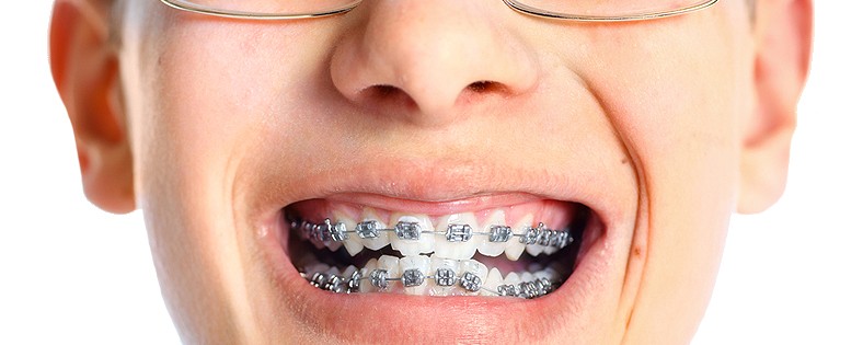 Problems_with_Braces_Retainers