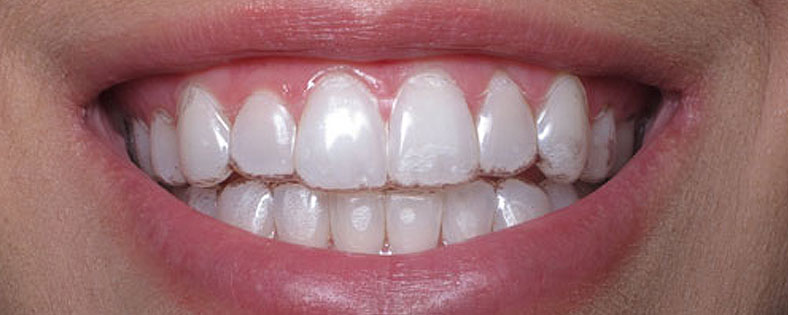 Invisalign Cambridge